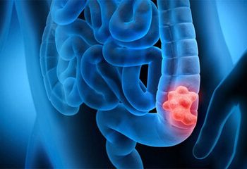 اولین علائم سرطان روده بزرگ را بشناسید