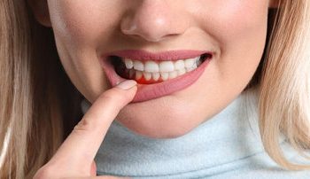 علت سیاهشدن لثهها چیست؟