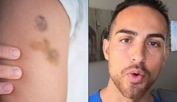 علت برخی کبودیهای بدون دلیل بدن چیست؟