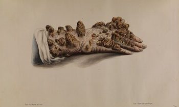 عفونتی به قدمت تاریخ؛ مبدأ جذام کجا بود؟/ موفقیت ایران در حذف این بیماری/ کدام استانها جذامخیز بودند؟