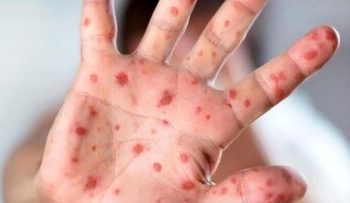 شیوع بیماری واگیردار در کشور؛ اگر واکسن نزنید تا ۹۰ درصد منتقل میشود