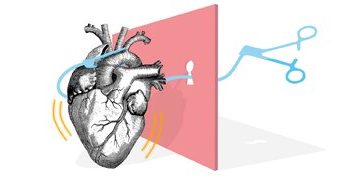 سیر تکامل جراحی قلب؛ از بخیه تا پیوند/ نخستین دریافتکننده پیوند قلب چند روز زنده ماند؟