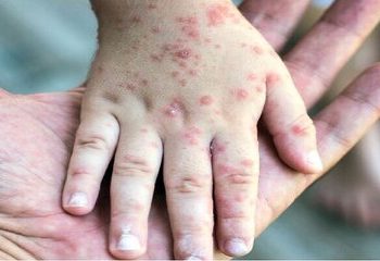 دلایل افزایش ابتلا به سرخک طی روزهای اخیر