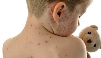 الگوسازی ایران برای کشورهای همسایه در حذف سرخک