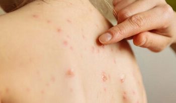 نقش آموزش عمومی و اعتمادسازی در موفقیت واکسیناسیون سرخک در کشور/ ایران، یکی از چهار کشور دارای گواهی حذف سرخک