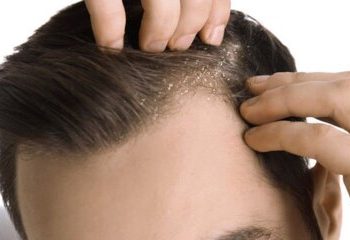 مهم‌ترین علت‌های شوره سر