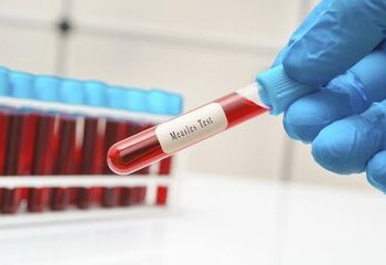 واکسیناسیون سرخک در کشورهای جهان/ کدام کشورها سرخک را حذف کرده‌اند؟/ وضعیت ایران