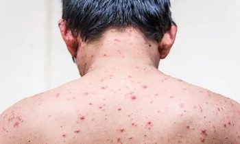 علائم آبلهمرغان در بزرگسالان